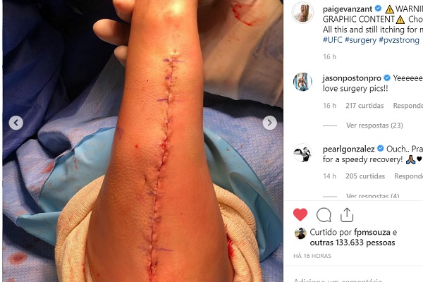 Imagens fortes! Paige VanZant mostra detalhes da terceira cirurgia no braço