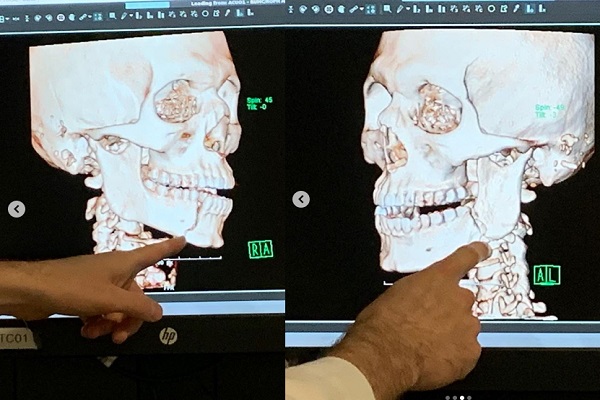 Ricardo Lamas encara cirurgia após sofrer três fraturas no maxilar em luta no UFC 238