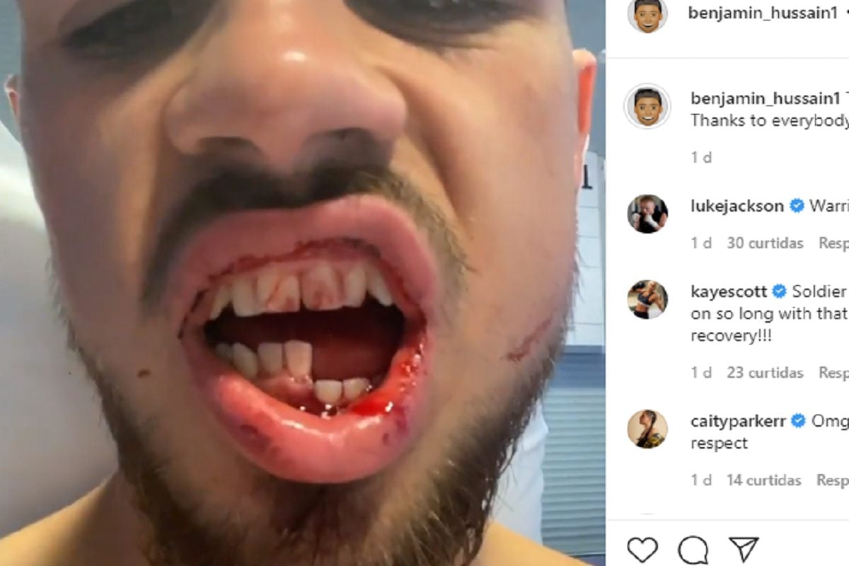 Imagem forte! Boxeador australiano revela lesão na mandíbula após duelo
