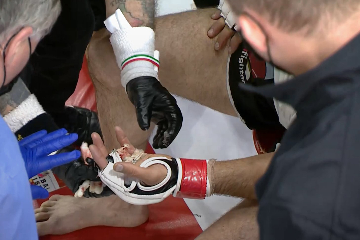Treinador revela que lutador que quase perdeu o dedo “tentou esconder lesão”
