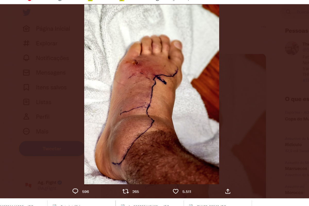 Hospitalizado, Dustin Poirier impressiona ao compartilhar foto do pé inchado; veja