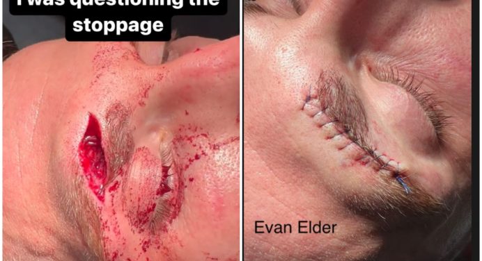 Imagem forte! Dana White mostra corte profundo de lutador após UFC Vegas 69