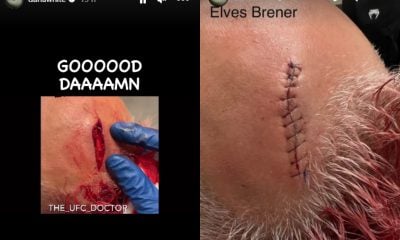 Antes e depois da intervenção médica no corte sofrido por Elves Brener no UFC Vegas 76.