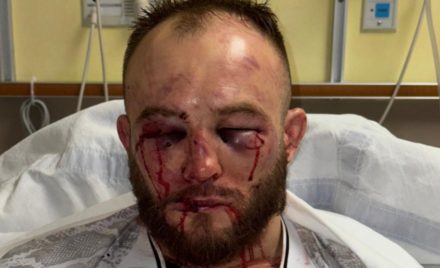 O rosto desfigurado de Mateusz Rebecki após a derrota para Diego Ferreira no UFC St Louis.